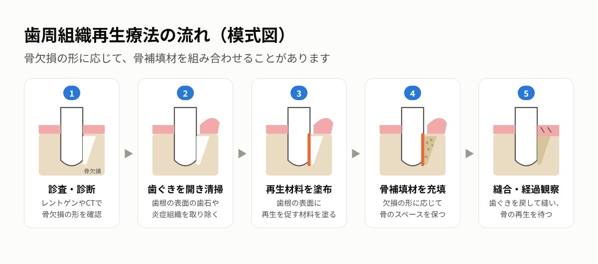 歯周組織再生療法の流れの模式図（診査・診断、歯ぐきを開き清掃、再生材料を塗布、骨補填材を充填、縫合・経過観察）