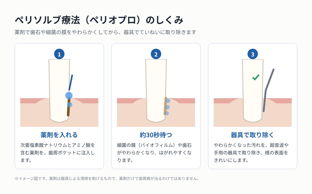 ペリソルブ療法のしくみ(薬剤を入れる→約30秒待つ→器具で取り除く)
